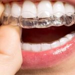 Personalised Invisalign Treatment Plans: What Londoners Need to Know