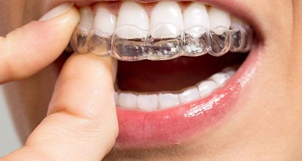 Personalised Invisalign Treatment Plans: What Londoners Need to Know