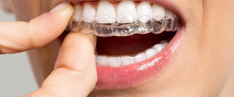 Personalised Invisalign Treatment Plans: What Londoners Need to Know