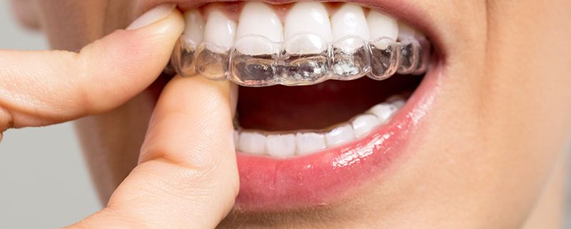 Personalised Invisalign Treatment Plans: What Londoners Need to Know